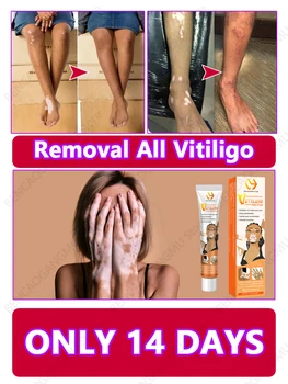 Krema za uklanjanje Vitiligo Uklanjanje Vitiligo Najbolja Sredstva Protiv Vitiliga Prirodne Biljne Ekstrakte Za Uklanjanje Vitiligo