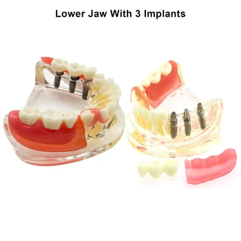 Model zuba s 3 implantata u donjoj čeljusti Izmjenjivi мостовидный proteze za komunikaciju sa stomatologa Pokazni model učenja pacijenata stomatologije